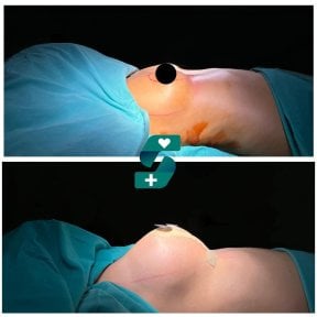 Vorher-nachher Brustvergrößerung bei Soraca Med – verbessertes Brustkontur-Ergebnis