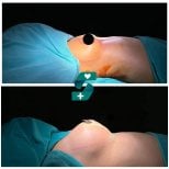 Vorher-nachher Brustvergrößerung bei Soraca Med – verbessertes Brustkontur-Ergebnis