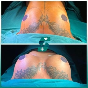 Vorher-nachher Brustvergrößerung bei Soraca Med, sichtbare Volumenzunahme