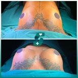 Vorher-nachher Brustvergrößerung bei Soraca Med, sichtbare Volumenzunahme