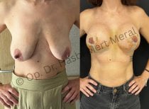 Before and after breast augmentation results at Mert Meral Clinic, improved breast shape