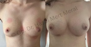 Before and after breast augmentation results at Mert Meral Clinic, enhanced breast volume