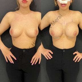 Before and after breast augmentation results at Mert Meral Clinic, enhanced breast volume