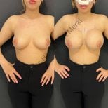 Before and after breast augmentation results at Mert Meral Clinic, enhanced breast volume