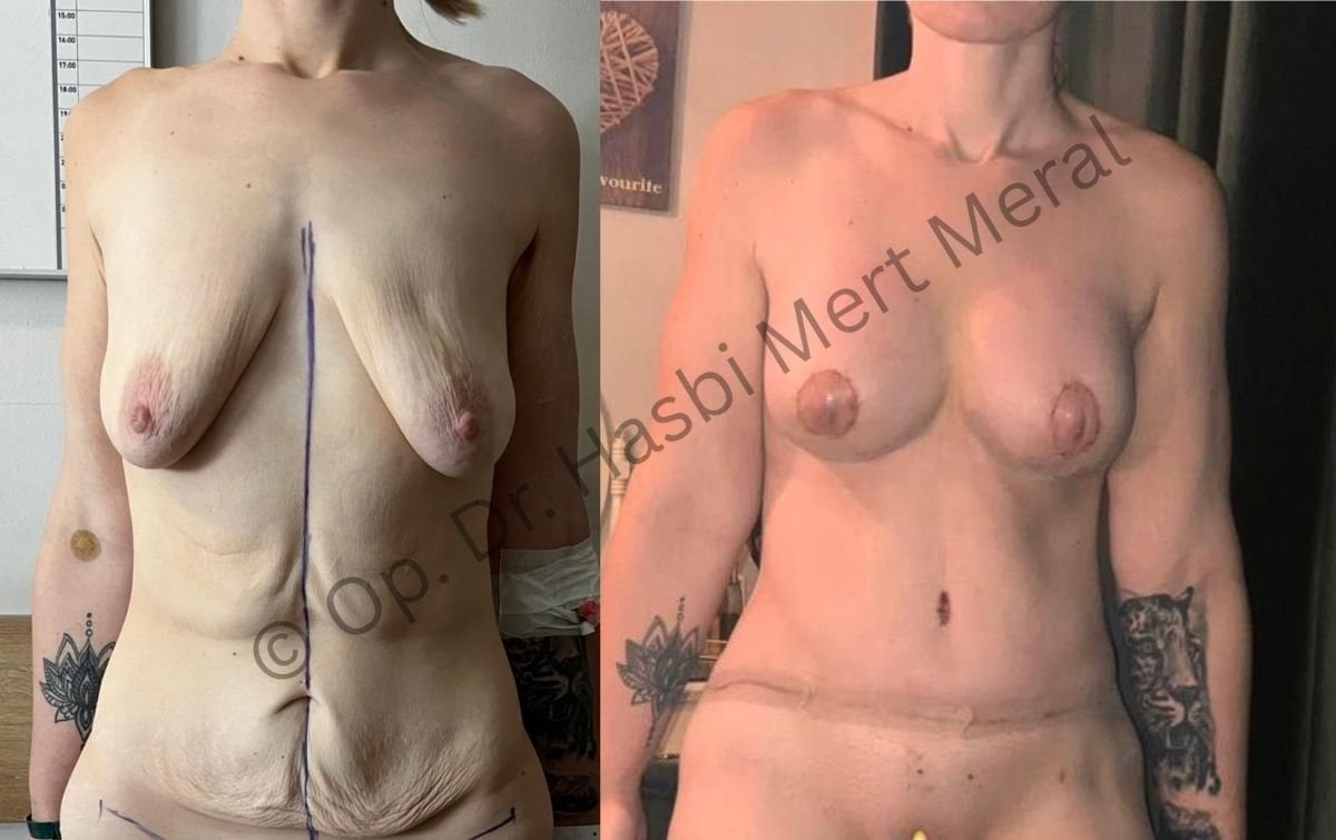 نتيجة قبل وبعد تكبير الثدي ونحت الجسم في عيادة Mert Meral