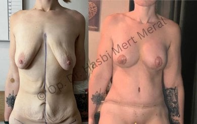 Before and after breast augmentation and body contouring result at Mert Meral Clinic