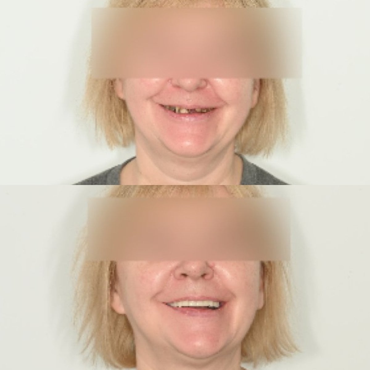 Resultados antes y después de implantes All-on-4 en Unident Clinic: sonrisa restaurada