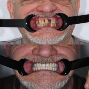 Before and after dental implant results at Unident Clinic – restored smile and teeth alignment