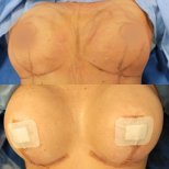 Before and after breast augmentation results at Meliva Kardiolita Hospital, enhanced volume