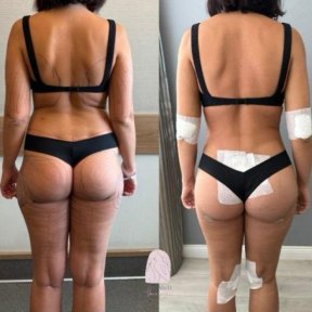 before-after photo liposuction