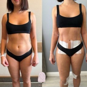 before-after photo liposuction