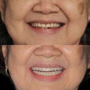 Результат до и после установки All-on-6 в Clínica Zago, улучшение эстетики улыбки