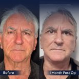 Vorher-nachher-Ergebnis des Facial Fat Transfer in der Dr. Safa Manav Klinik, 1 Monat post-op