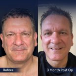 Vorher-nachher-Ergebnis des Facial Fat Transfer bei Dr. Safa Manav Clinic, 3 Monate post-op