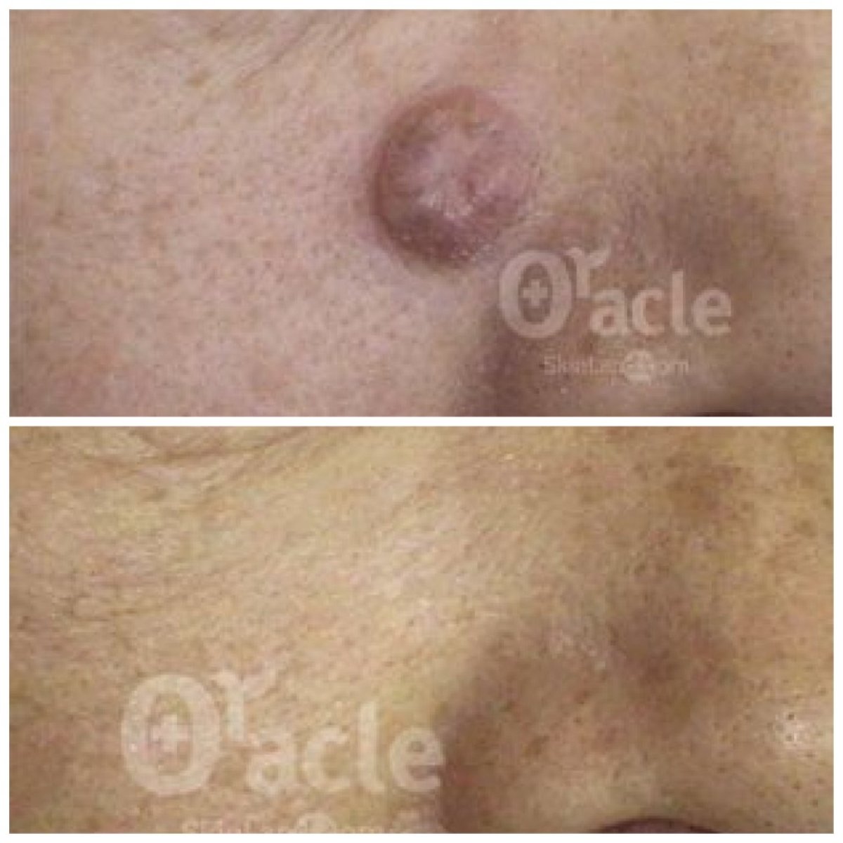 نتائج قبل وبعد إزالة الشامة في Oracle Clinic Cheongdam، تحسن واضح للبشرة
