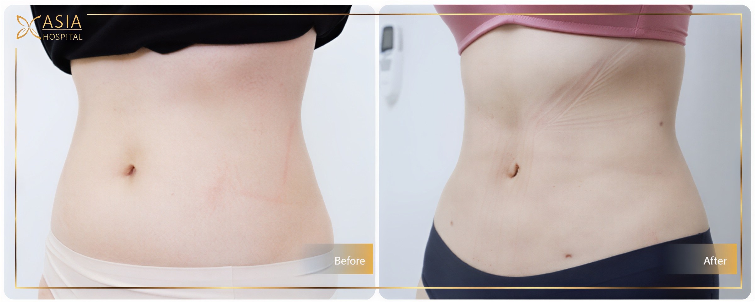 نتائج شفط الدهون 360 قبل وبعد في Asia Cosmetic Hospital، تحديد واضح للخصر