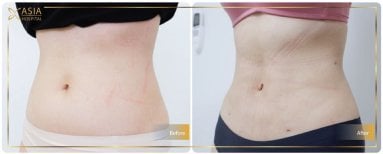 Before and after 360 liposuction results at Asia Cosmetic Hospital, visible waist contouring