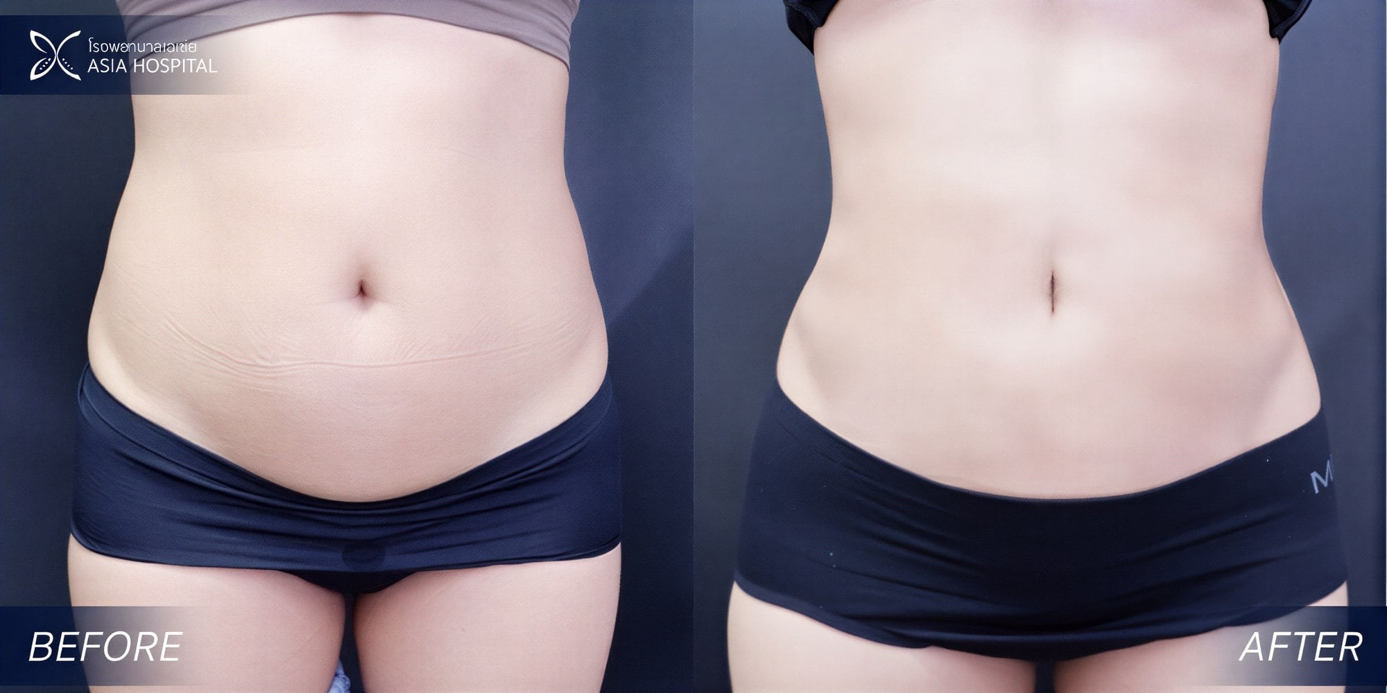 Resultados de liposucción 360 antes y después en Asia Cosmetic Hospital, contorno visible