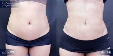 Before and after 360 liposuction results at Asia Cosmetic Hospital, visible waist contouring