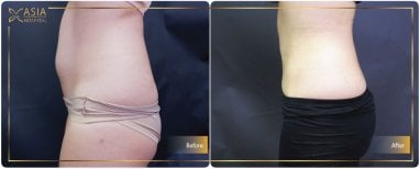 Before and after 360 liposuction results at Asia Cosmetic Hospital, improved body contour