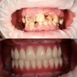 Résultat avant/après implants All-on-6 à la RIKOTA Dental Clinic, restauration complète du sourire