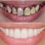 Before and after dental implant results at BMC Dental Klinik – restored healthy smile