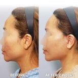 Результаты до и после фейслифтинга в Returning Plastic Surgery – улучшение контура лица