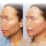 Результаты до и после подтяжки лица в Returning Plastic Surgery, видимое омоложение лица