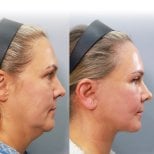 Результаты до и после подтяжки лица в Returning Plastic Surgery – улучшение контура лица