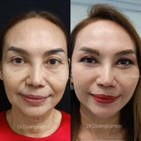 Facelift Vorher-Nachher-Ergebnisse in Yanhee International Hospital, Gesichtsverjüngung