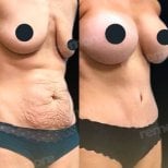 Resultados antes y después de aumento de senos y abdominoplastia en Memorial Bahçelievler Hospital