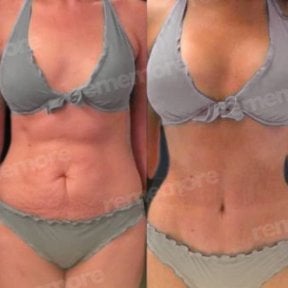 Before and after tummy tuck results at Memorial Bahçelievler Hospital, visible flatter abdomen