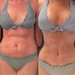 Before and after tummy tuck results at Memorial Bahçelievler Hospital, visible flatter abdomen