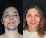 Результаты блефаропластики верхних век до и после в клинике Dr. Safa Manav, омоложение глаз