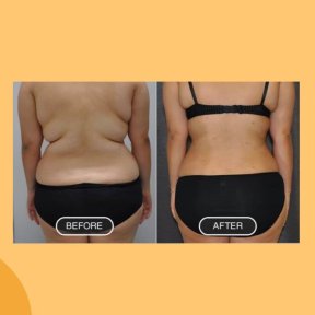 before-after photo liposuction