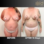 Vorher-nachher-Ergebnis Bauchdeckenstraffung bei ID Clinic Bangkok, sichtbare Konturverbesserung