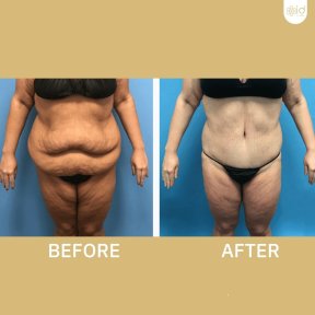 Vorher-nachher-Ergebnis Bauchdeckenstraffung bei ID Clinic Bangkok, sichtbare Konturverbesserung