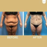 Vorher-nachher-Ergebnis Bauchdeckenstraffung bei ID Clinic Bangkok, sichtbare Konturverbesserung