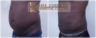 360 liposuction before and after results at Asia Cosmetic Hospital, visible abdominal contouring