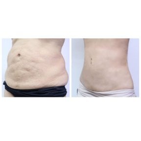 Before and after 360 liposuction results at Asia Cosmetic Hospital, improved abdominal contour
