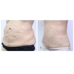 Before and after 360 liposuction results at Asia Cosmetic Hospital, improved abdominal contour