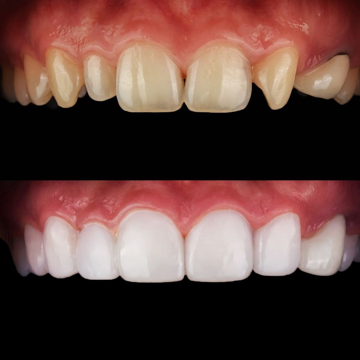 Resultado antes y después de carillas en 365SeoulOneTop365 Dental Clinic, transformación de sonrisa