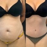 Before and after 360 liposuction results at Memorial Bahçelievler Hospital, body contouring