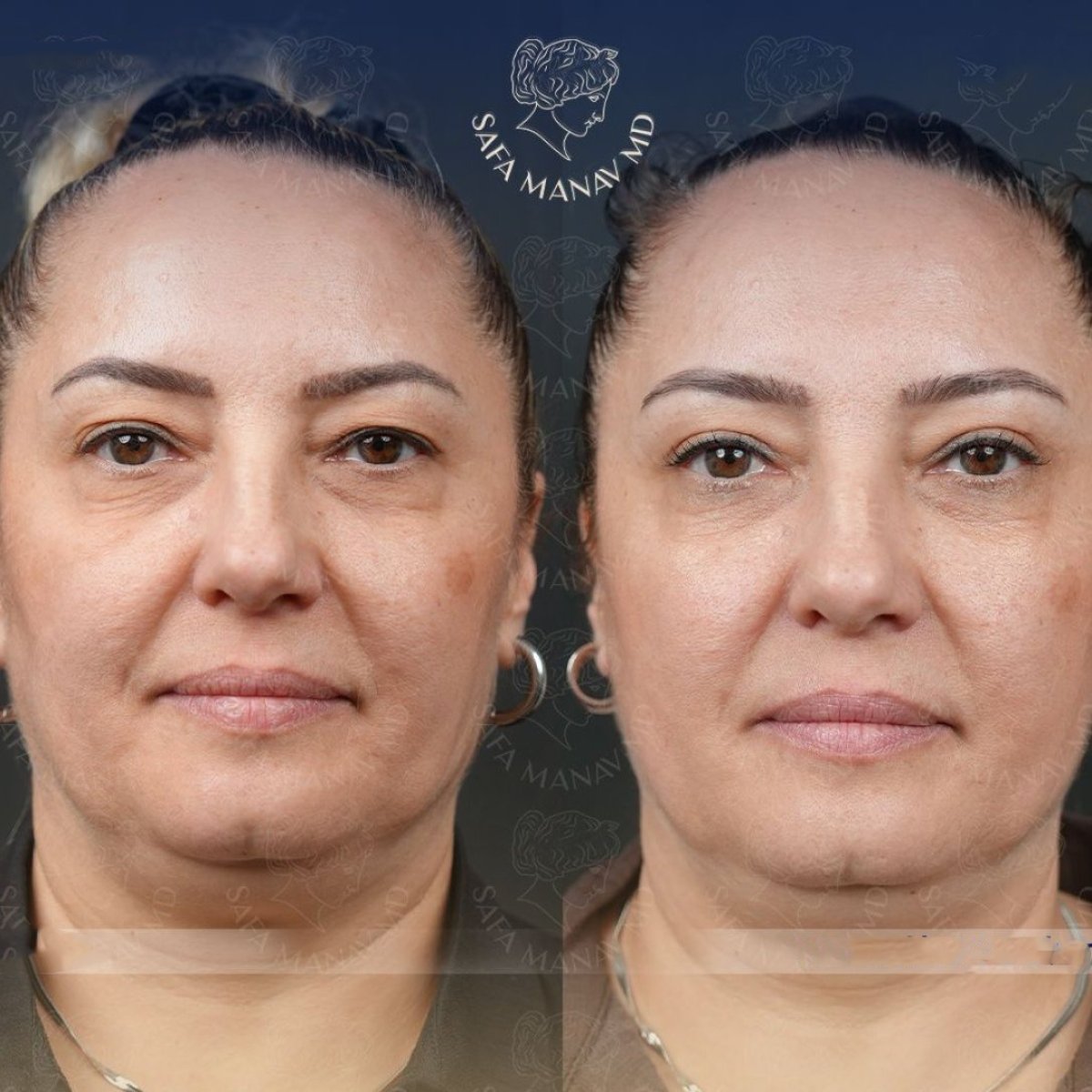 نتائج عملية شد الجفن العلوي قبل وبعد في عيادة Dr. Safa Manav، تجديد منطقة العين