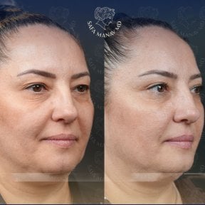 Результаты блефаропластики верхних век до и после в клинике Dr. Safa Manav, омоложение глаз
