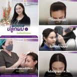 Dr.  тарапынан Шашты қырмай көшіріп салу бұрын және кейін фотосуреттері