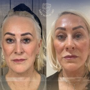 Facial fat transfer before and after results at Dr. Safa Manav Clinic, rejuvenated appearance