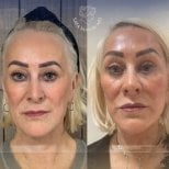 Facial fat transfer before and after results at Dr. Safa Manav Clinic, rejuvenated appearance