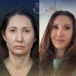 Before and after facial fat transfer results at Dr. Safa Manav Clinic, rejuvenated appearance