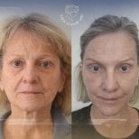 Before and after facial fat transfer result at Dr. Safa Manav Clinic, rejuvenated appearance